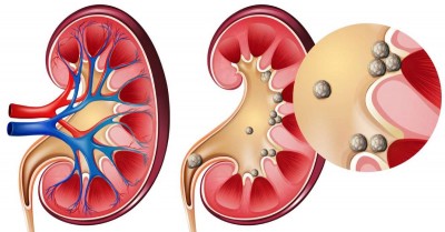 Kidney Stones - renal calculi
