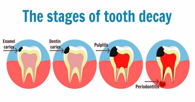 What Is Periodontitis and Home Remedies To Treat It